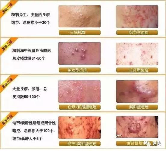 女性三角毛毛区长了个硬疙瘩