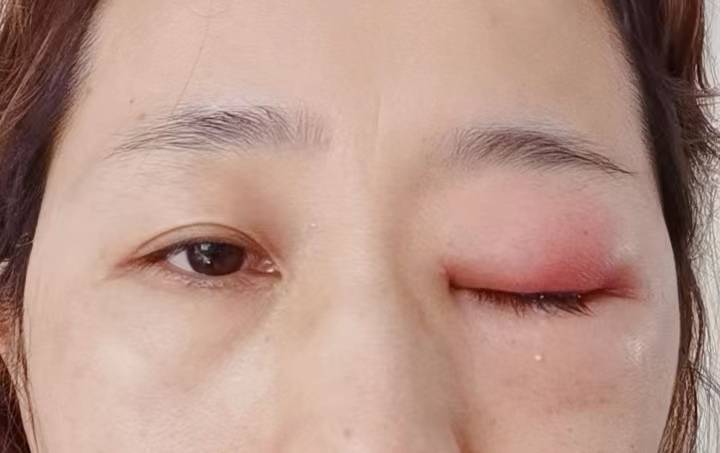 红肿疼痛小缝不能合拢
